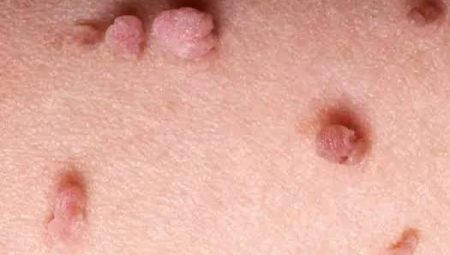 Ayakta ve genital bölgede çıkan siğile dikkat!